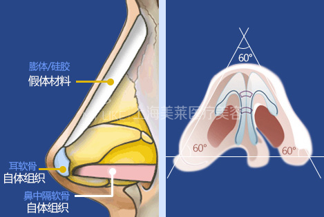 假体隆鼻