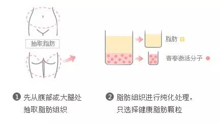 自体脂肪移植填充 瘦这里 美那里