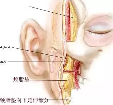 颊脂垫去除术后注意事项